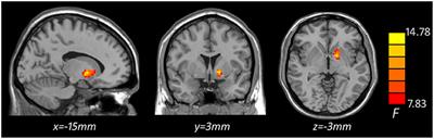 Increased plasma levels of IL-6 are associated with striatal structural atrophy in major depressive disorder patients with anhedonia